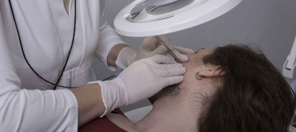 Haarentfernung Berlin, Behandlung Gesicht
