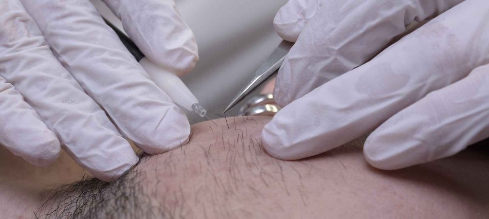 Haarentfernung Berlin, Behandlung Gesicht